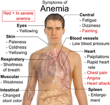 220px-Symptoms_of_anemia.png Hosting at Sudaneseonline.com