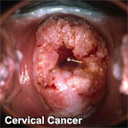 cervicalcancersm.jpg Hosting at Sudaneseonline.com